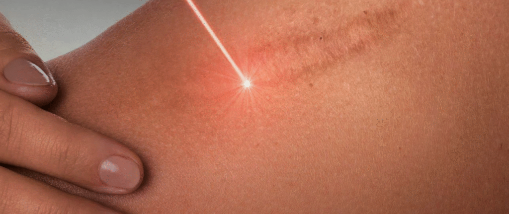Laser Scar Resurfacing Kyiv